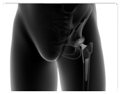 Direct Anterior Hip Replacement Surgery